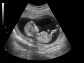  Ultrasonido prenatal puede identificar signos de autismo 