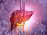 Sistema de puntuación predice riesgo de mortalidad en pacientes con hepatitis alcohólica