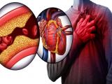 Tomografía en diagnóstico de enfermedad coronaria obstructiva