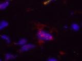 Análisis fecal para la detección del cáncer de páncreas