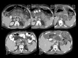 Drenaje endoscópico para pancreatitis necrótica 