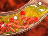 Combinación de análisis clínico y genético mejora el diagnóstico de hipercolesterolemia 