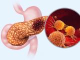 Directrices para el cribado del cáncer de páncreas