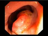 Dostarlimab conduce remisión de cáncer colorrectal 
