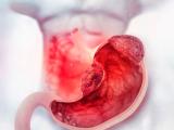 Estado civil influye en la supervivencia por cáncer gástrico 