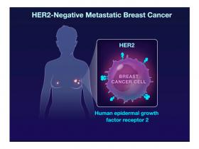Trastuzumab deruxtecan muestra eficacia en cáncer de mama 