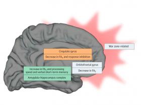 Estrés relacionado a la guerra provoca cambios en la microestructura del cerebro