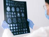 Eficacia de la estimulación cerebral profunda para el TOC resistente 
