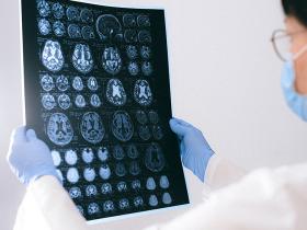 Eficacia de la estimulación cerebral profunda para el TOC resistente 
