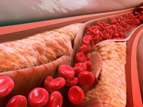 ARN de interferencia para controlar enfermedades cardiovasculares