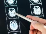Tratamiento de la epilepsia mediante terapia génica 