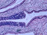 La carga de cáncer cervicouterino sigue siendo elevada 