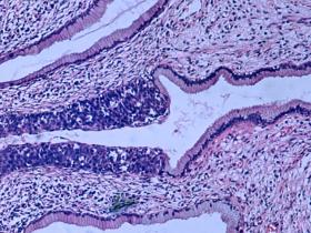 La carga de cáncer cervicouterino sigue siendo elevada 