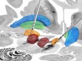 Programación automatizada de la estimulación cerebral profunda 
