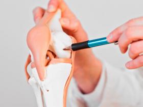 Metformina reduce significativamente el riesgo de prótesis articular 