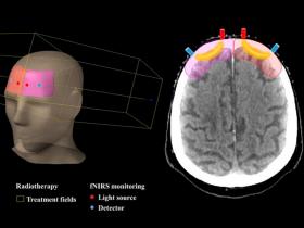 Oxigenación del tejido cerebral para radioterapia personalizada 