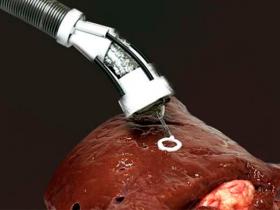 Bioimpresión en 3D dentro del cuerpo humano 