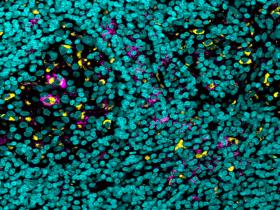 Cambio molecular en un anticuerpo acelera respuesta inmunitaria contra el cáncer
