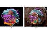 Abordaje tubular parafascicular para la resección de tumores cerebrales en áreas elocuentes