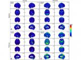 Traumatismos cerebrales recurrentes pueden aumentar el riesgo de Alzheimer