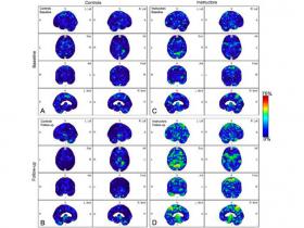 Traumatismos cerebrales recurrentes pueden aumentar el riesgo de Alzheimer