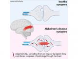 Sinapticoligomérica del Alzheimer: posible causa de la propagación en el cerebro