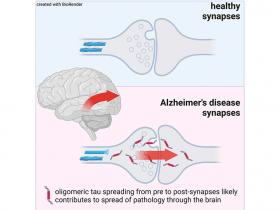 Sinapticoligomérica del Alzheimer: posible causa de la propagación en el cerebro