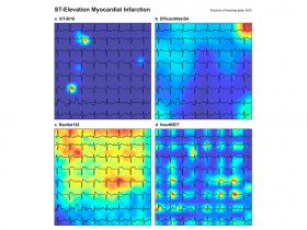 Deep learning para el análisis de electrocardiogramas 