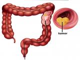 Cambios en la expresión de genes asociados a cáncer colorrectal