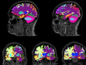 Grasa abdominal afecta la salud del cerebro