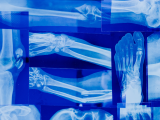 Rol del microbioma intestinal en la salud ósea