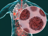 Beneficios clínicos de la inmunoterapia en cáncer pulmonar