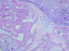 Aplicación innovadora de machine learning en el osteosarcoma