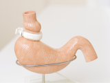 Efectos post cirugía bariátrica en presencia de H. pylori