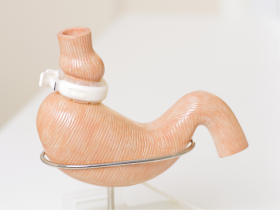 Efectos post cirugía bariátrica en presencia de H. pylori