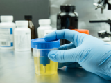 Biomarcadores urinarios revelan la salud renal y cardiometabólica