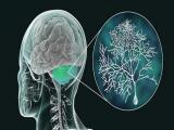Anomalía genética oculta tras una ataxia cerebelosa de aparición tardía