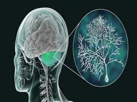 Anomalía genética oculta tras una ataxia cerebelosa de aparición tardía