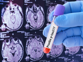 Prueba sanguínea detecta con precisión el alzhéimer