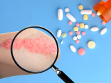 Uso efectivo de un péptido terapéutico para la psoriasis