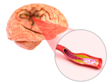 Terapia anticoagulante para el ACV no difiere de la antiplaquetaria