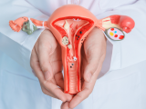 Histerectomía simple no es inferior a la radical en cáncer cervicouterino