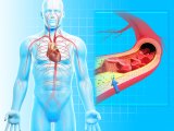 Micro y nanoplásticos como factores de riesgo cardiovascular