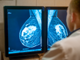 Modelo basado en IA como predictor de cáncer de mama