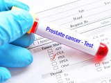 Práctica clínica que salva vidas en cáncer de próstata