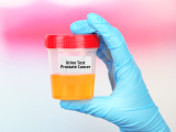 Prueba urinaria detecta cáncer de próstata con gran precisión