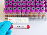 PSA supera a la resonancia magnética en el cribado del cáncer de próstata