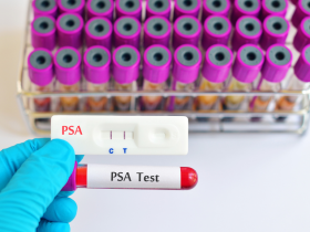 PSA supera a la resonancia magnética en el cribado del cáncer de próstata