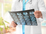 Avances en la predicción del deterioro cognitivo en alzhéimer