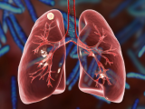 La tos no es un síntoma común en la tuberculosis pulmonar